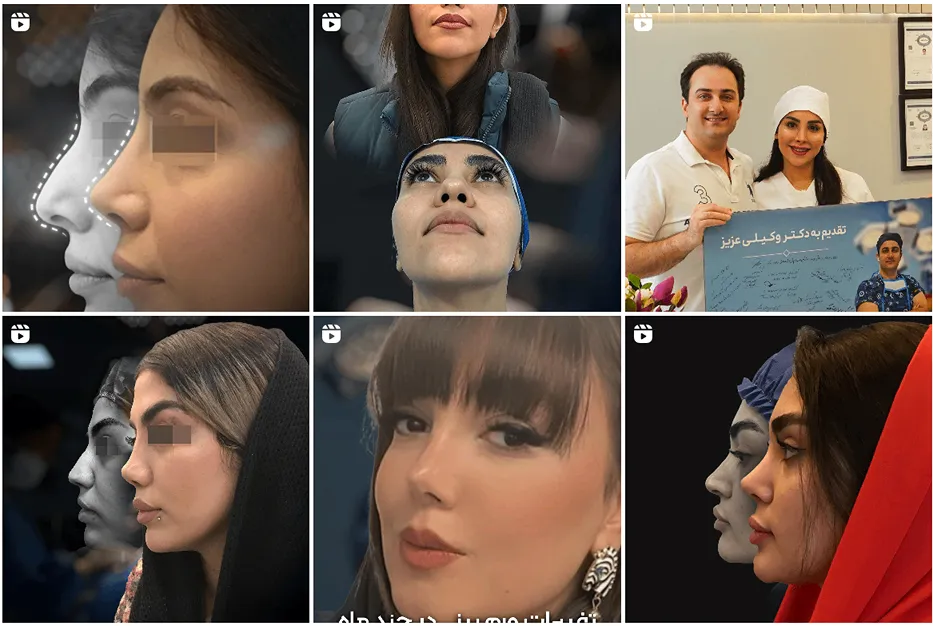 دکتر وکیلی از بهترین جراح بینی مشهد است