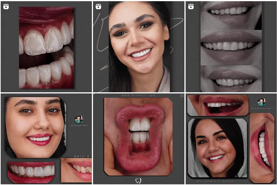 لمینت در مشهد توسط دکتر وکیلی قابل اجرا است