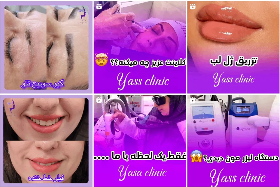 تزریق چربی در مشهد توسط کلینیک یاس کاملا قابل انجام است