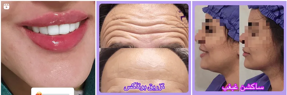 قیمت بوتاکس در مشهد بع عوامل کاملا مختلف و متفاوتی وابسته است