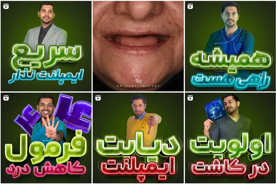 ایمپلنت در مشهد توسط دکتر زارع کاملا قابل انجام است