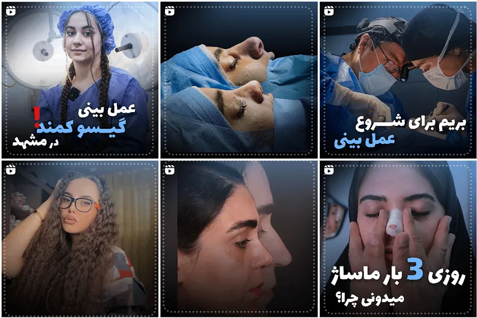 عمل بینی در مشهد توسط دکتر زرین قلم قابل انجام است