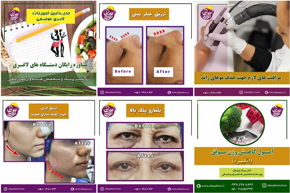 لیزر موهای زائد در مشهد در کلینیک زیبایی زیبا آفرین کاملا قابل اجرا است