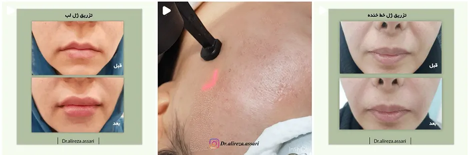 میکرونیدلینگ در مشهد توسط دکتر عصاری قابل انجام است