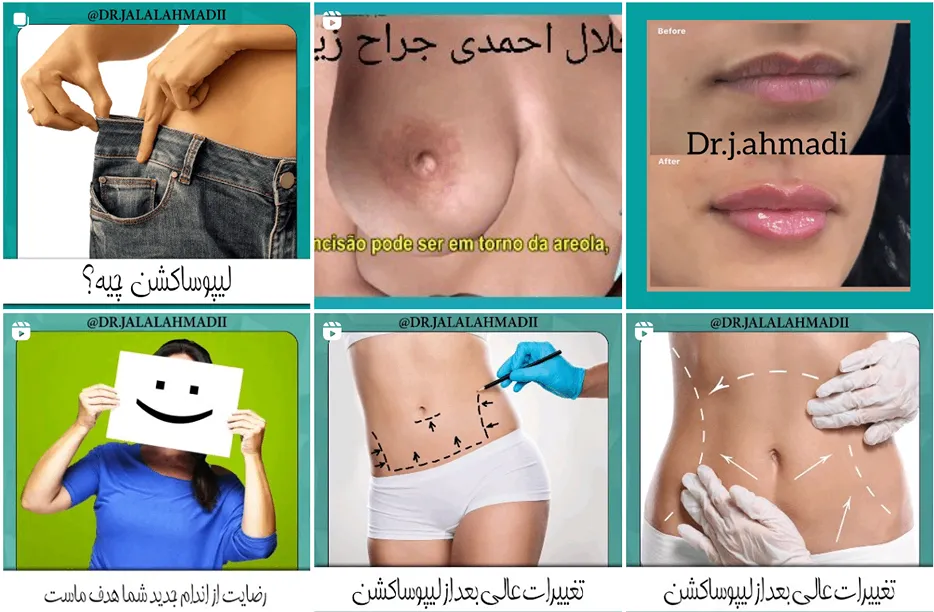 عمل ماموپلاستی در مشهد توسط دکتر احمدی قابل انجام است