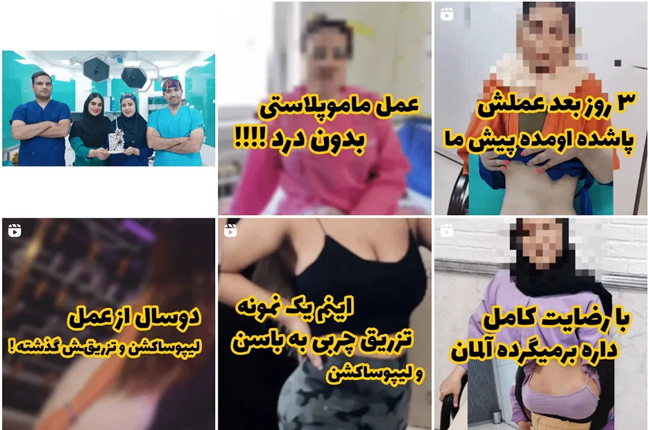 لیفت سینه در مشهد توسط دکتر برجسته قابل انجام است