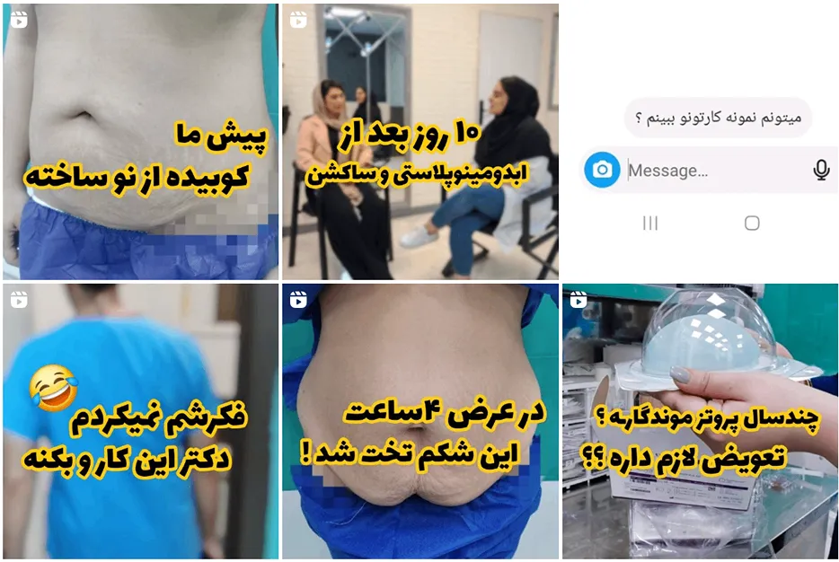 ابدومینوپلاستی در مشهد توسطدکتر عطاریان کاملا قابل انجام است