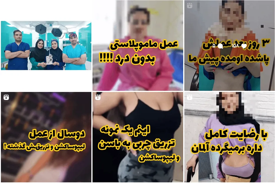 لیپوساکشن در مشهد توسط دکتر عطاریان کاملا قابل انجام است