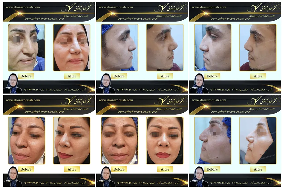 جراحی بینی استخوانی در مشهد توسط دکتر آرنوش قابل انجام است