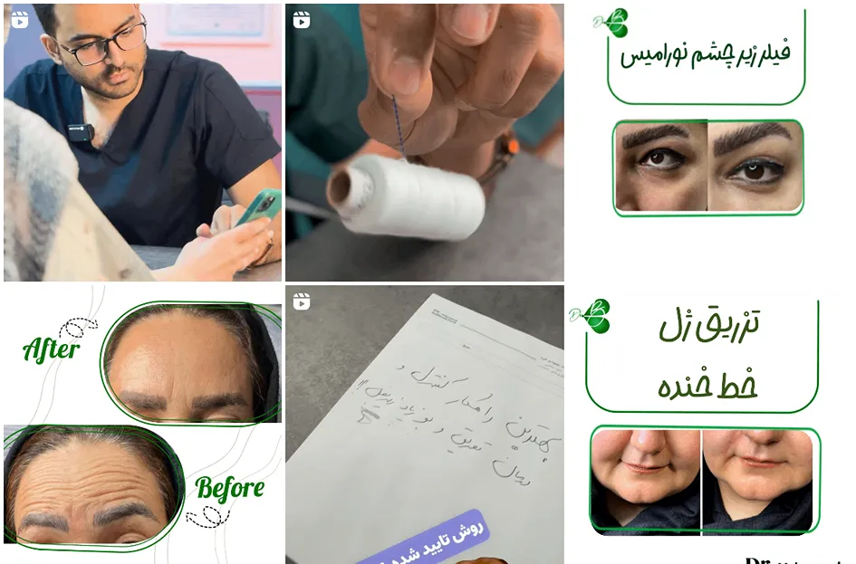 لیفت با نخ در مشهد توسط دکتر بهبودی فرد قابل انجام است