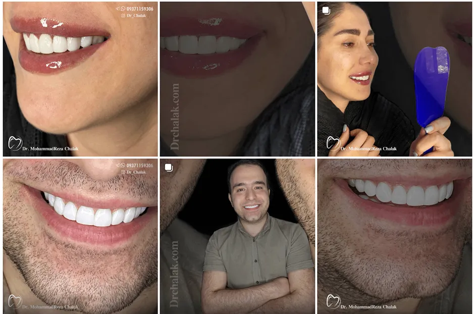 نمونه کار دکتر چالاک از بهترین دکتر کامپوزیت در مشهد را مشاهده میفرمایید.