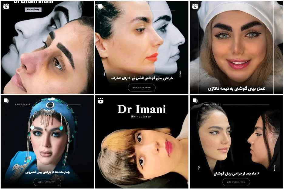 جراحی بینی استخوانی در مشهد توسط دکتر ایمانی قابل انجام است