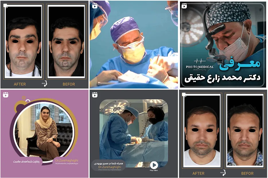 پروتز باسن در مشهد توسط دکتر حقیقی کاملا قابل انجام است