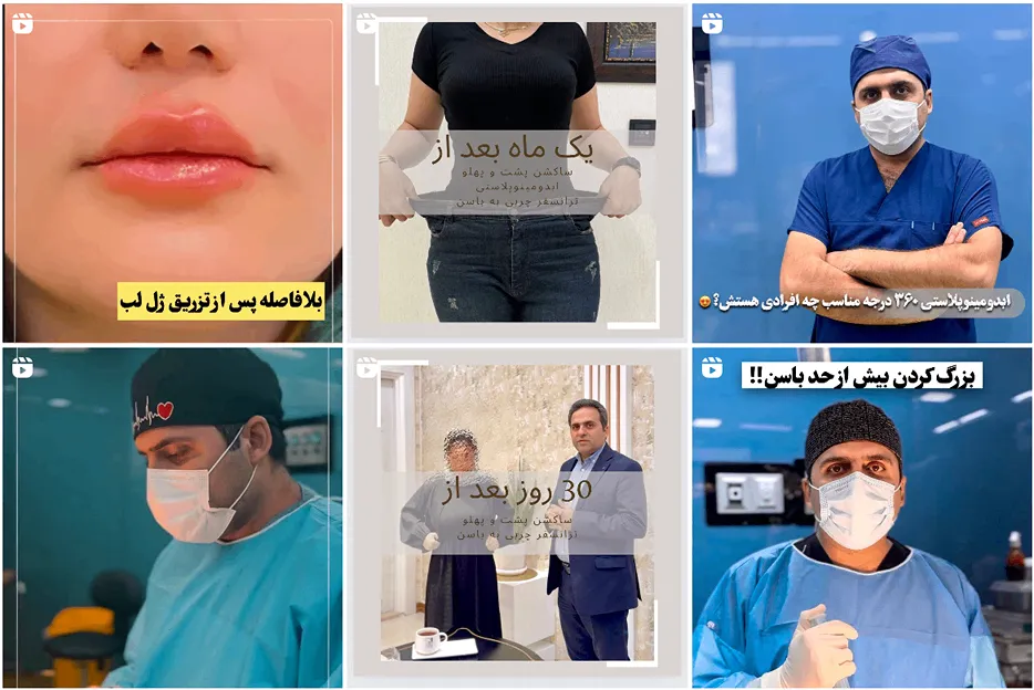 عمل لیپوساکشن در مشهد توسط دکتر جعفری قابل انجام است