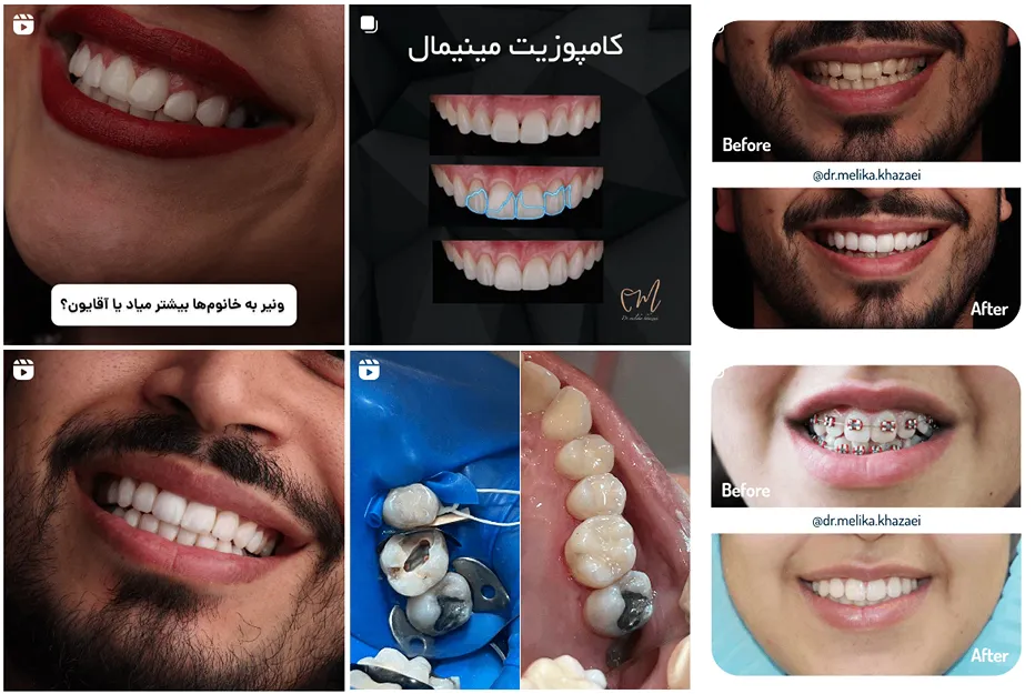 کامپوزیت دندان در مشهد توسط دکتر خزاعی قابل انجام است