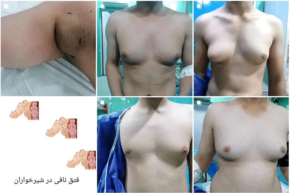 ژنیکوماستی در مشهد توسط دکتر کیقبادی کاملا قابل انجام است