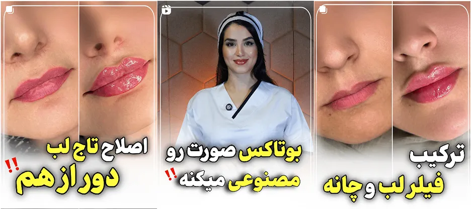 بوتاکس بحنورد در کلینیک دکتر غنی کاملا قابل اجرا است