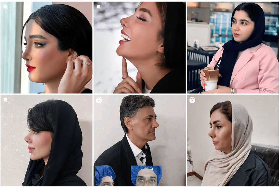 عمل بینی استخوانی در مشهد توسط دکتر متدین قابل انجام است