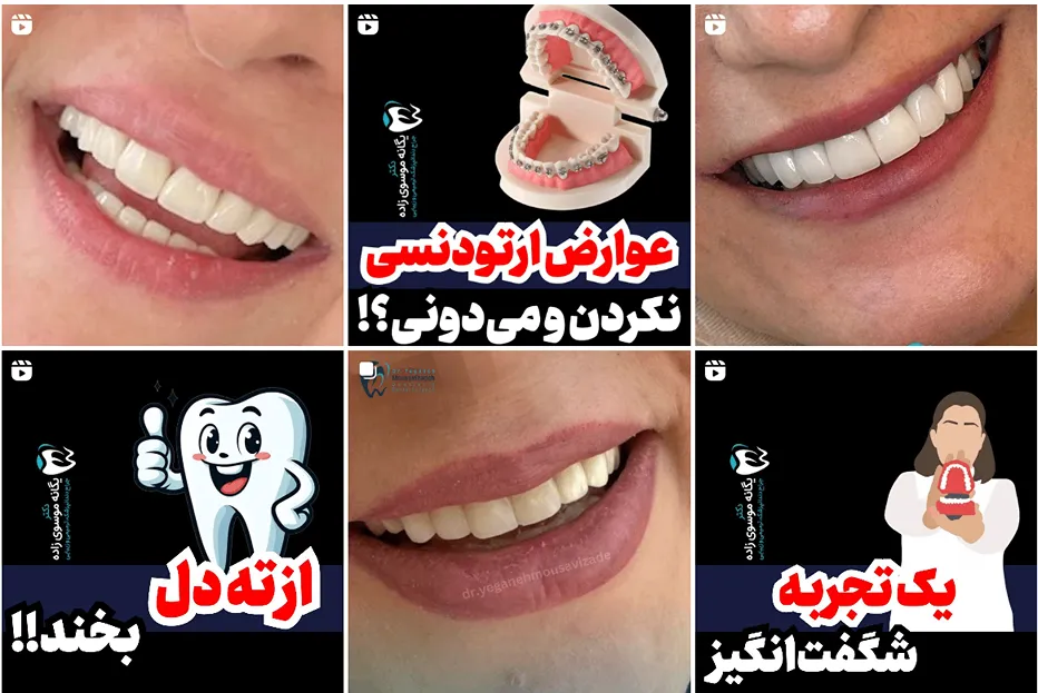 کامپوزیت دندان در مشهد توسط دکتر موسوی زاده کاملا قابل انجام است