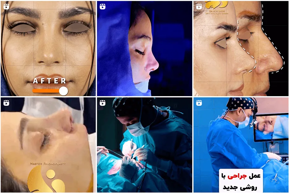 عمل بینی استخوانی در مشهد توسط دکتر صدر قابل انجام است
