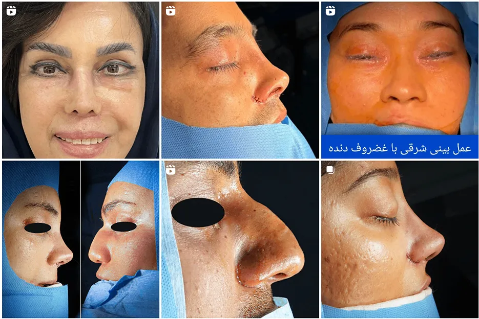 عمل بینی استخوانی در مشهد توسط دکتر غلامی کاملا قابل انجام است