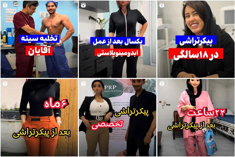 جراحی کوچک کردن سینه مردان در مشهد توسط دکتر قربانزاده کاملا قابل انجام است