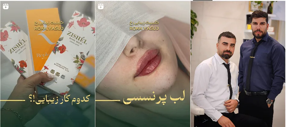 نمونه کار یکی از بهترین دکتر بوتاکس یاسوج را مشاهده میفرمایید.