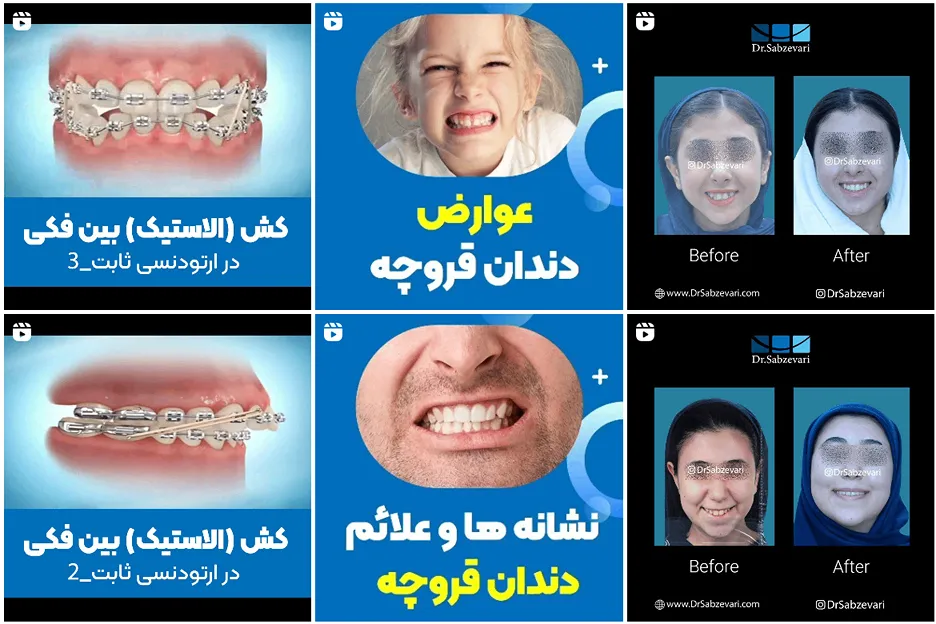 ارتودنسی در مشهدتوسط دکتر سبزواری کاملا قابل انجام است