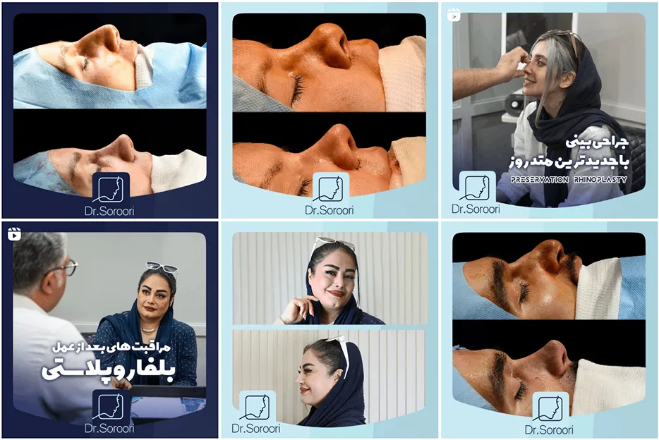 عمل بینی استخوانی در مشهد توسط دکتر سروی قابل انجام است