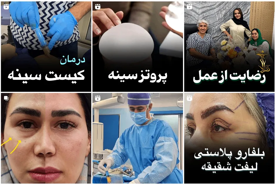 لیفت سینه در مشهد توسط دکتر طالب زاده قابل انجام است