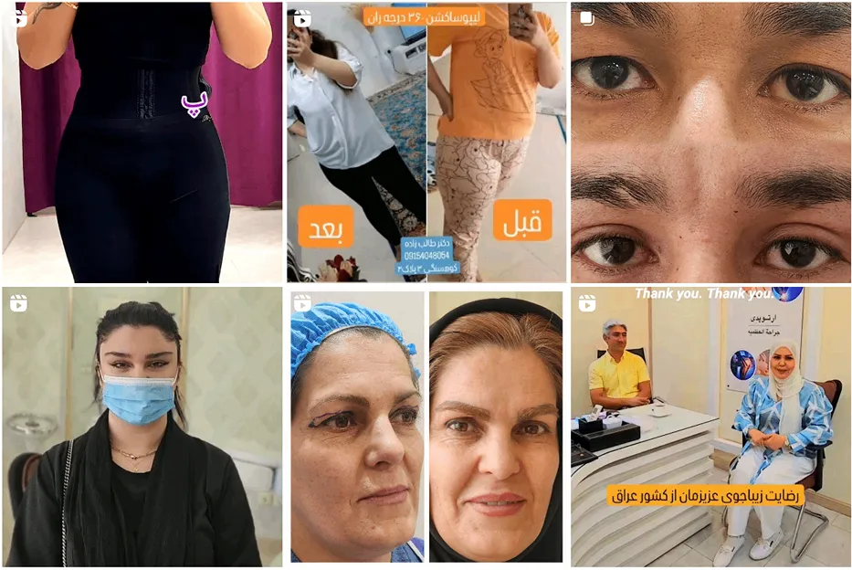 لیپوساکشن در مشهد توسط دکتر طالب زاده قابل انجام است