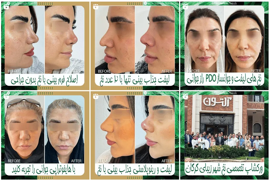 لیفت با نخ در مشهد توسط دکتر وکیلی کاملا قابل انجام است