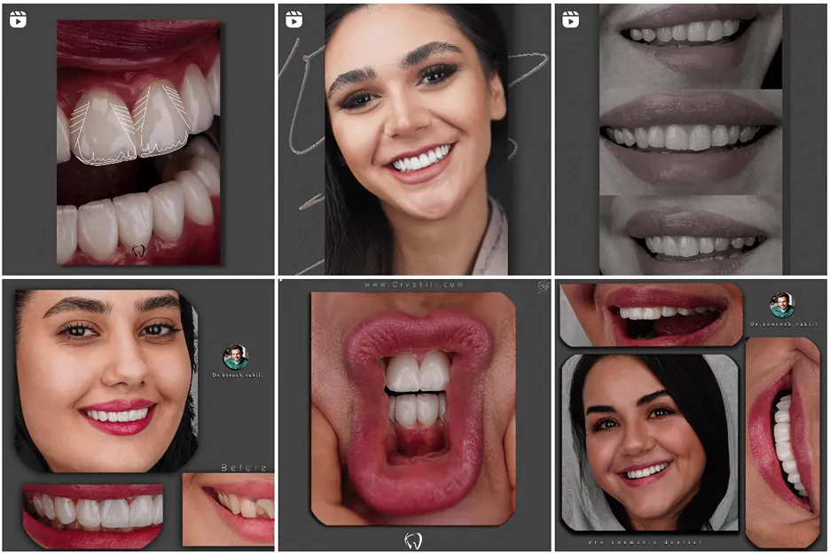 کامپوزیت در مشهد توسط دکتر وکیلی قابل انجام است