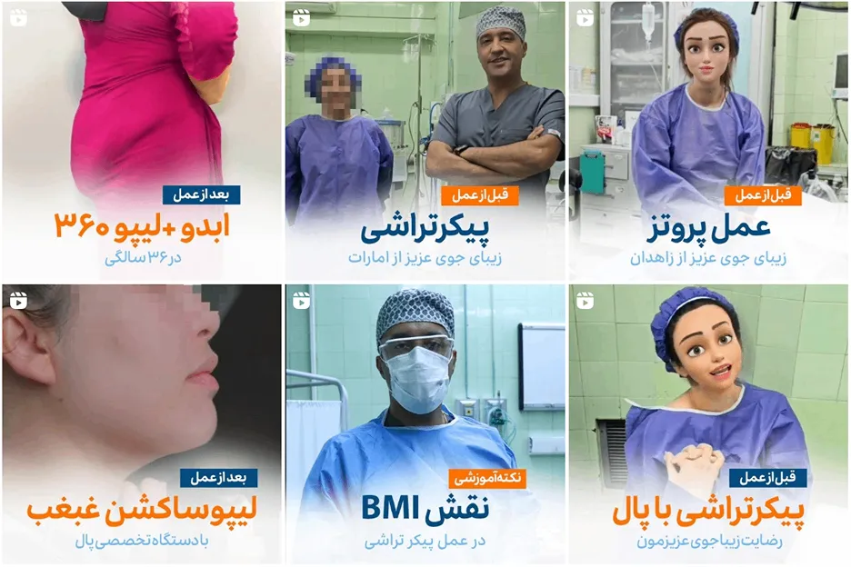 لیفت سینه در مشهد توسط دکتر یوسفی کاملا قابل انجام است