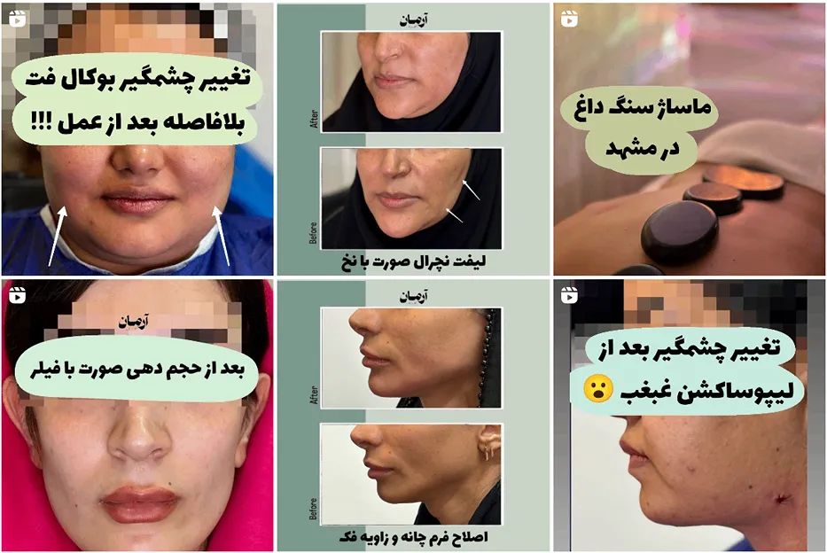 کلینیک ارمان یکی از بهترین جراح بوکال فت را در دارد