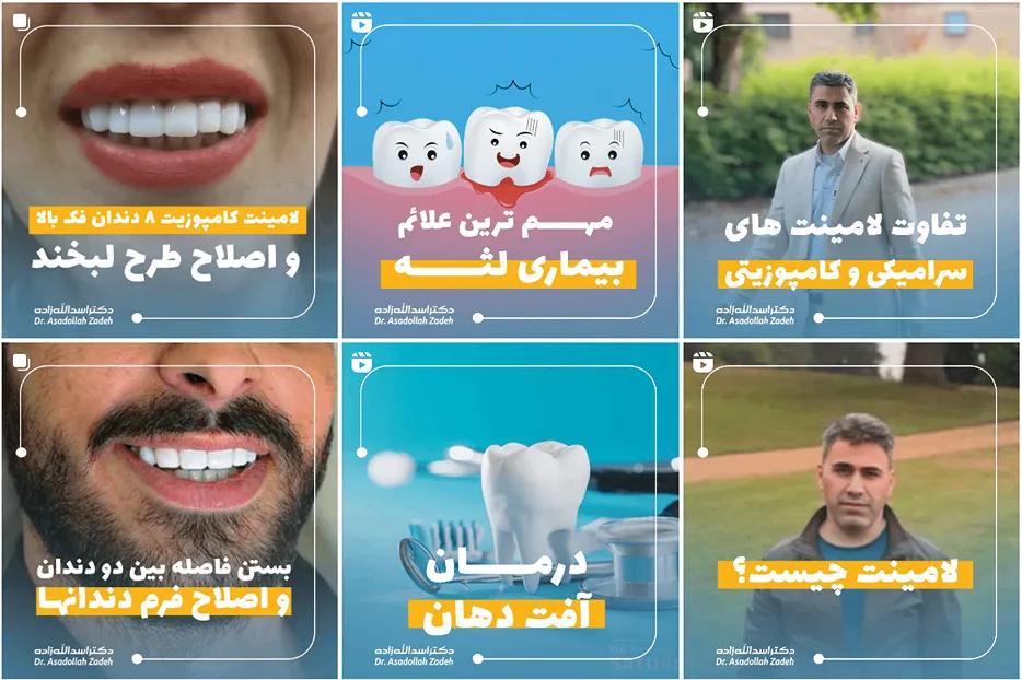 عصب کشی دندان در مشهد توسط دکتر اسدا.. زاده کاملا قابل انجام است