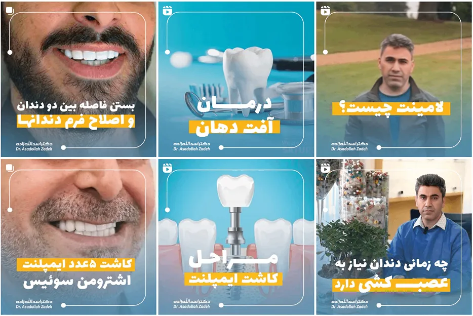 پروتز دندان در مشهد توسط دکتر اسدا.. زاده کاملا قابل انجام است