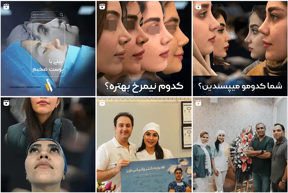 جراحی بینی گوشتی در مشهد توسط دکتر وکیلی قابل انجام است