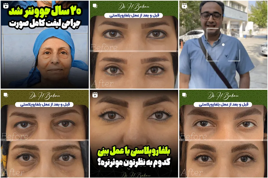 لیپوماتیک در مشهد توسط دکتر بابائی قابل انجام است