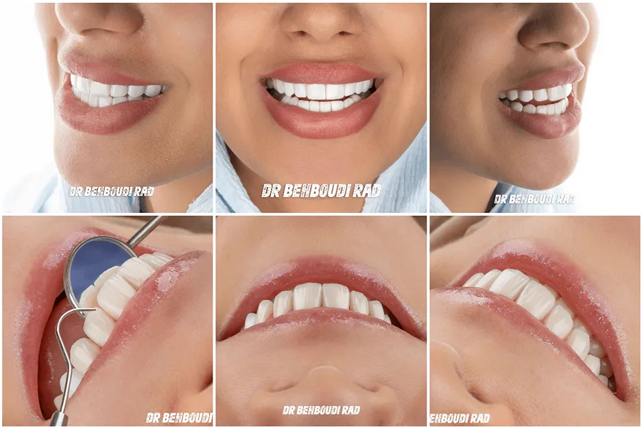 بلیچینگ در مشهد توسط دکتر بهبودی راد قابل انجام است