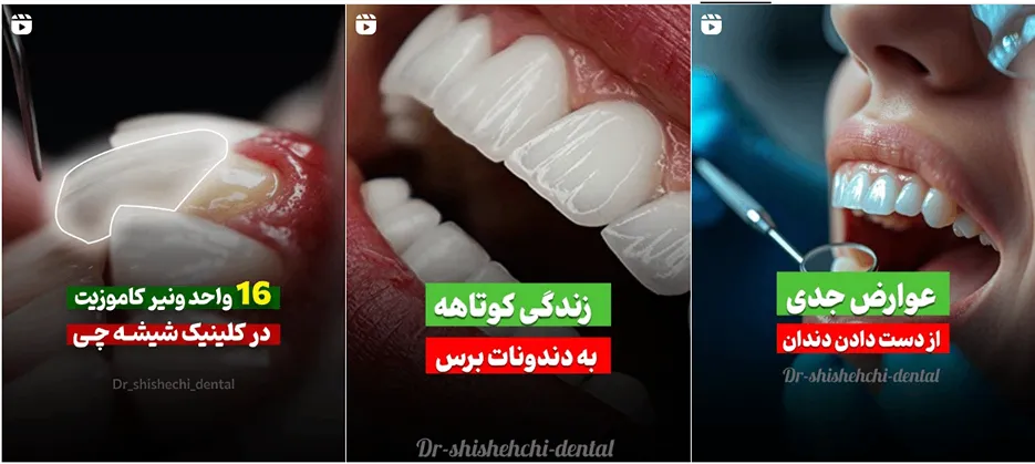 نمونه کار یکی از بهترین دکتر عصب کشی دندان در مشهد را مشاهده میفرمایید.