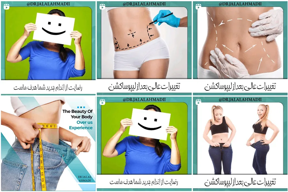 عمل لیپوماتیک در مشهد توسط دکتر احمدی قابل انجام است