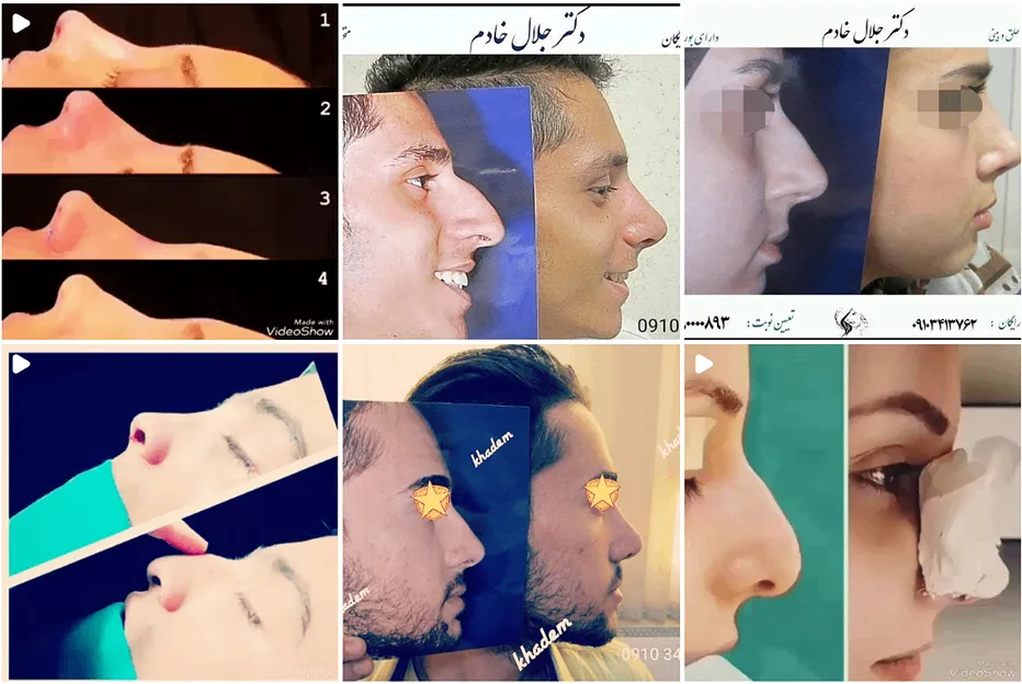 عمل بینی گوشتی در مشهد توسط دکتر خادم قابل انجام است