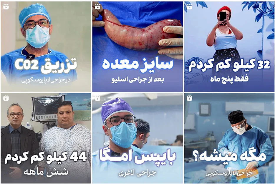 عمل بای پس معده در مشهدد توسط دکتر کلانتری قابل انجام است