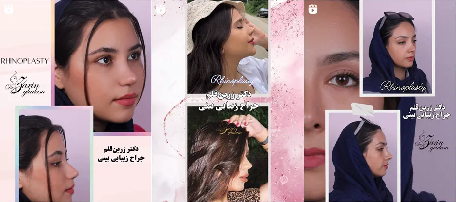 نمونه کار یکی دیگر از بهترین جراح بینی گوشتی در مشهد را میتوانید اینجا مشاهده بفرمایید.