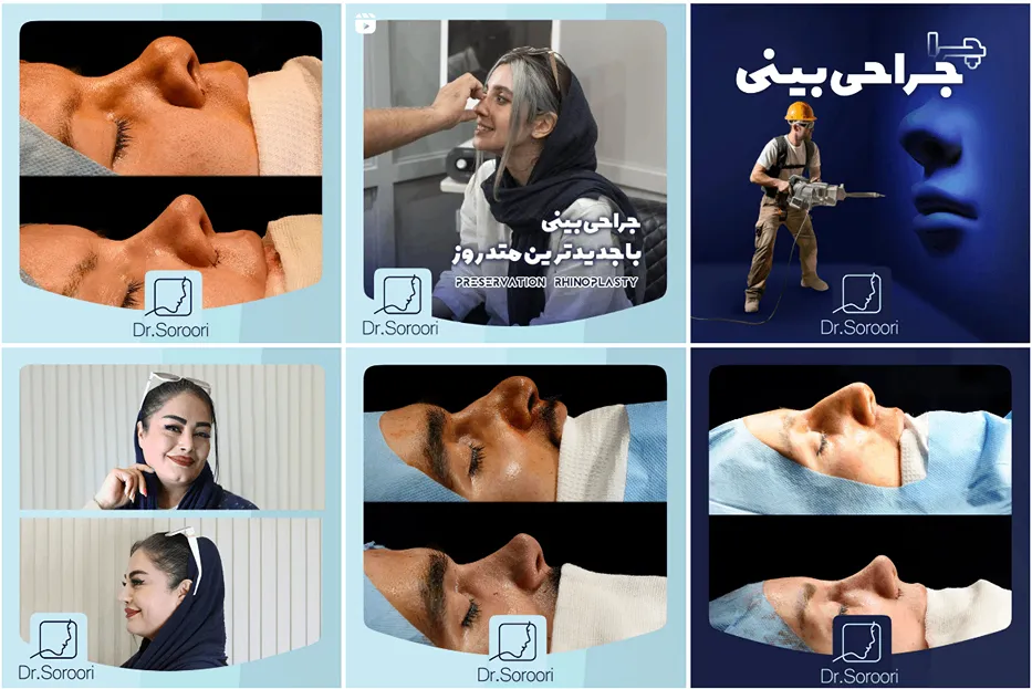 جراحی ترمیمی بینی در مشهد توسط دکتر سروی قابل انجام است