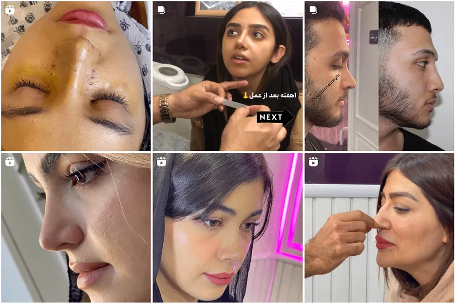 عمل بینی گوشتی در مشهد توسط دکتر صادقی قابل انجام است