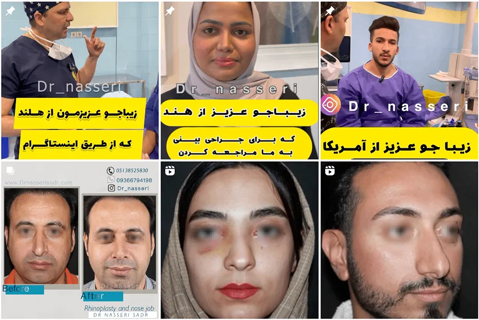 نمونه کار یکی از بهترین جراح بینی ترمیم در مشهد را مشاهده میفرمایید.