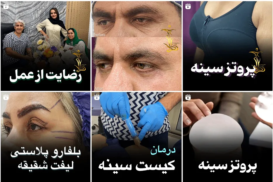 بوکال فت در مشهد توسط دکتر طالب زاده قابل انجام است