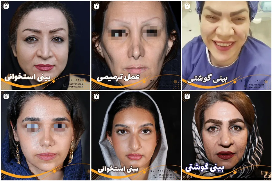 نمونه کار بهترین دکتر ترمیم بینی در مشهد را میتوانید مشاهده بفرمایید.